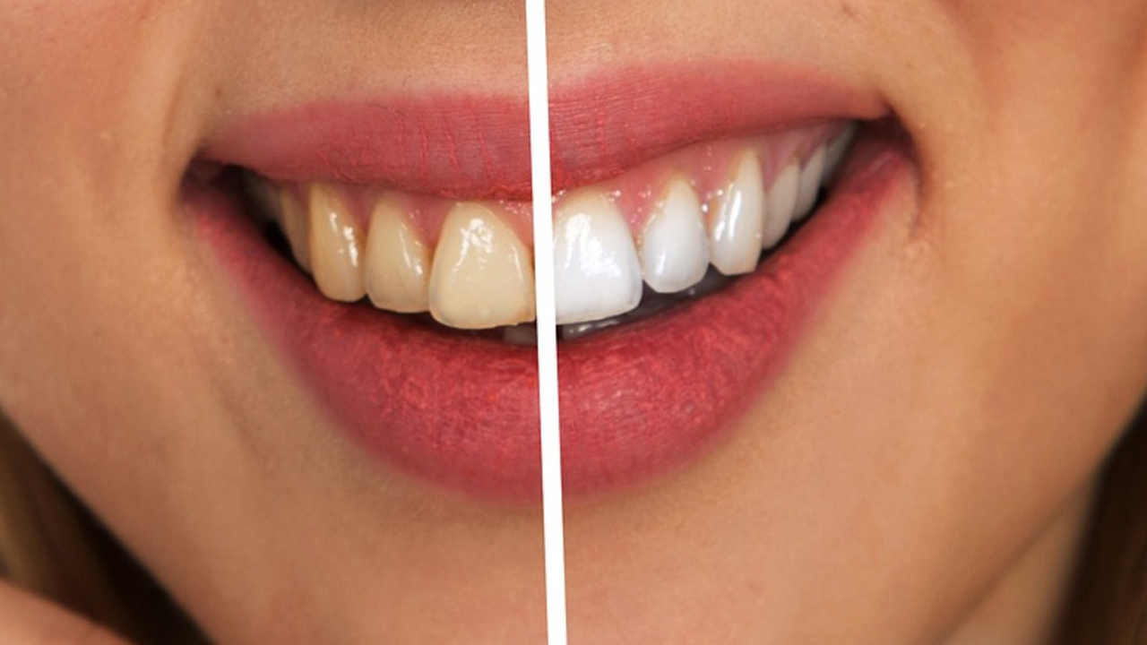 Homemade Teeth Whitening Solution – See Here