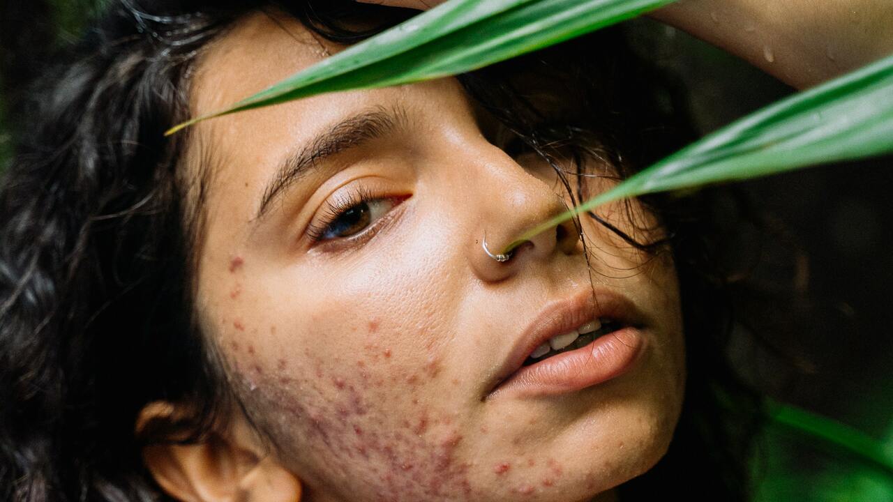 how-to-remove-acne-scars-naturally-8-effective-solutions-utopia